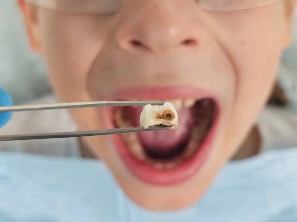 Urgent Tooth Repair in WY